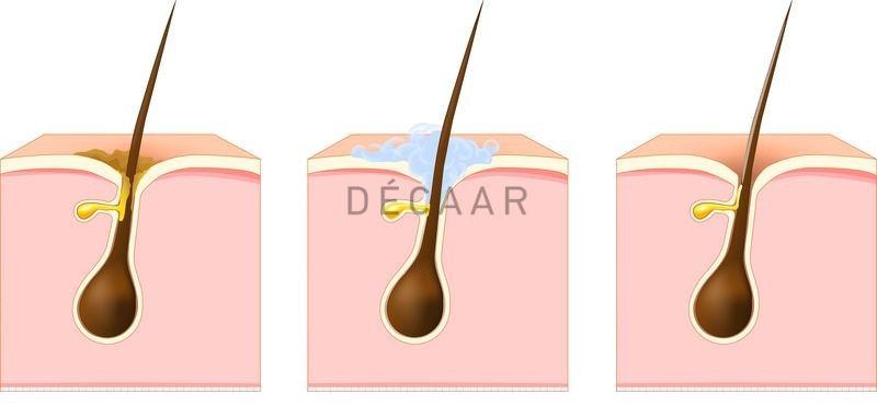 mụn ẩn sưng đỏ